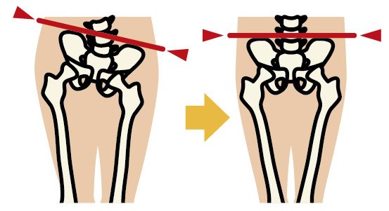 骨盤のゆがみ