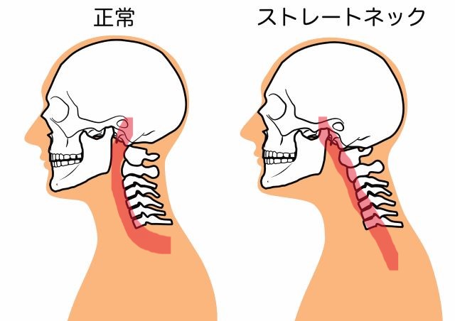 ストレートネックの症状